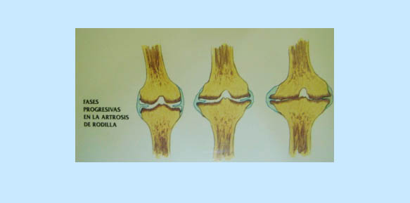 Artrosis de rodilla  Doctor Javier Vaquero Ruipérez
